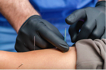 Recover, Dry needling, IASTM, scraping