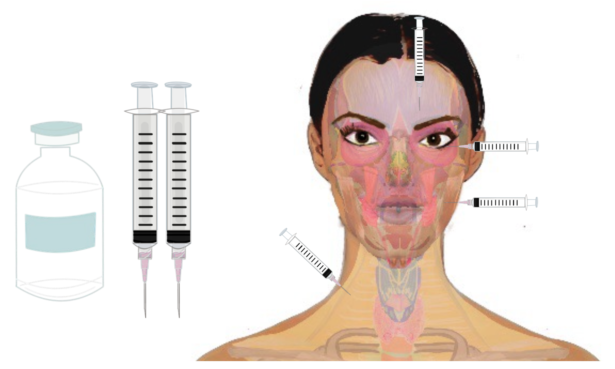 The effects of onabotulinumtoxinA on anxiety: A systematic review and quantitative analysis