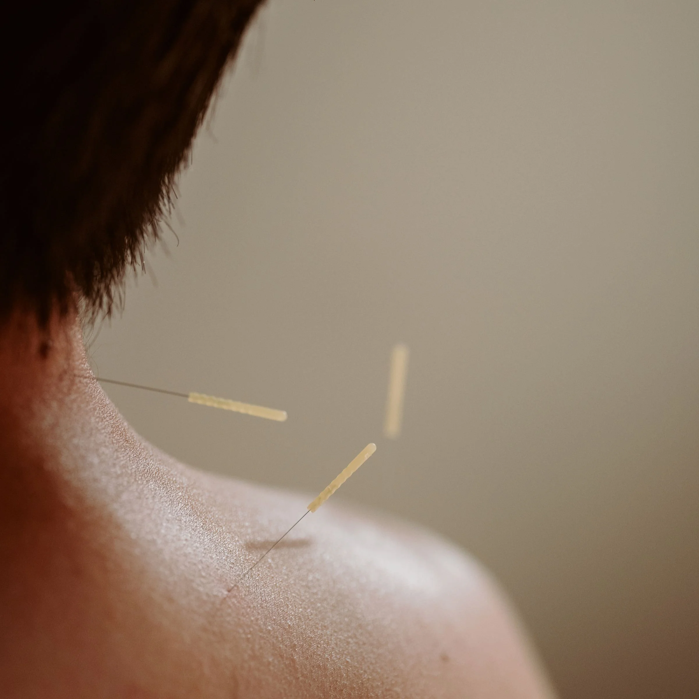 Top-rated licensed acupuncturist Emma Cheung at Acupuncture Specialists, 200 E Campus View Blvd, Suite 200, Columbus OH 43235. Treating back & neck pain, headaches, arthritis, insomnia, anxiety, infertility, allergies. Serving Greater Columbus area