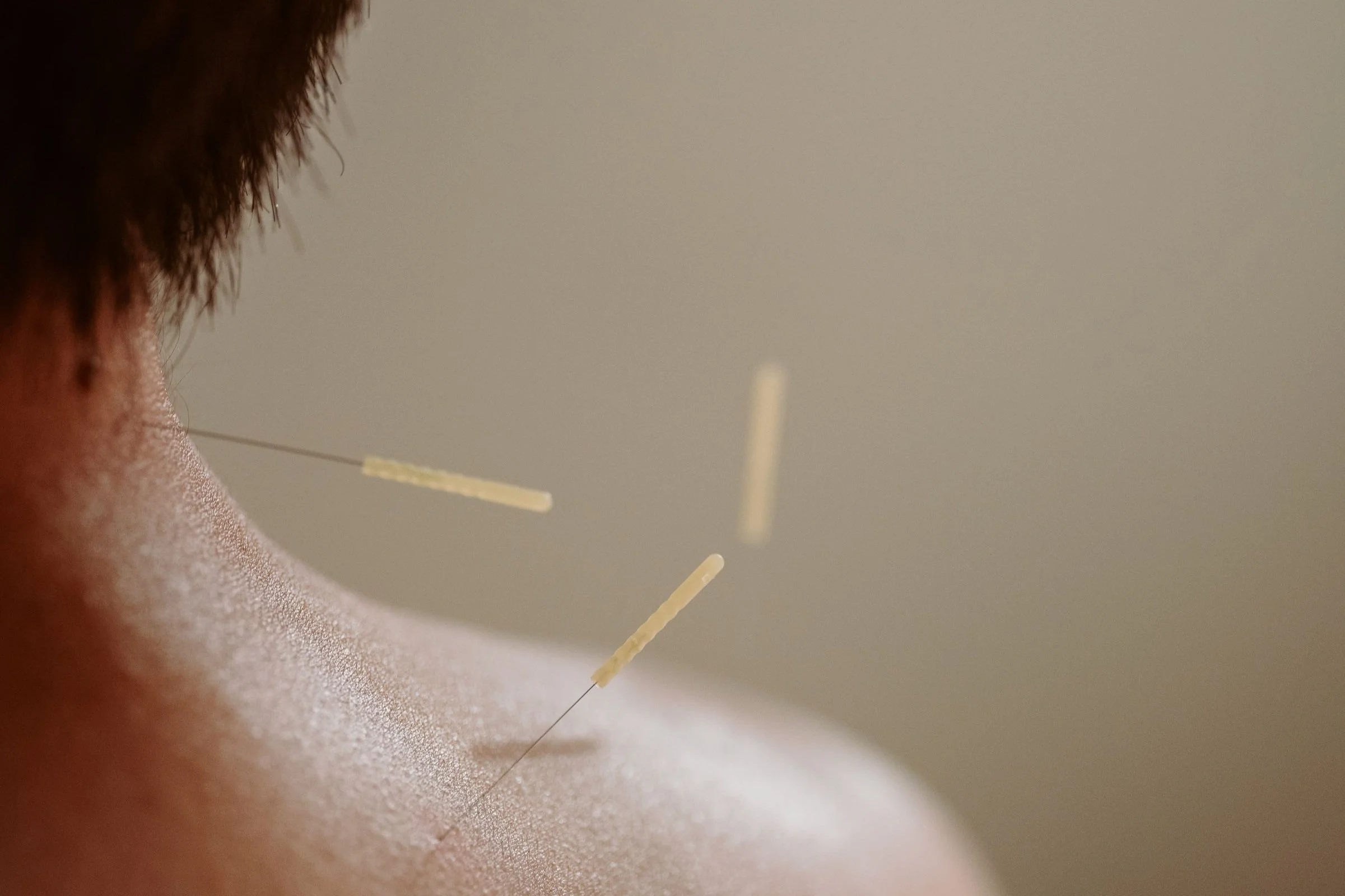 Top-rated licensed acupuncturist Emma Cheung at Acupuncture Specialists, 200 E Campus View Blvd, Suite 200, Columbus OH 43235. Treating back & neck pain, headaches, arthritis, insomnia, anxiety, infertility, allergies. Serving Greater Columbus area