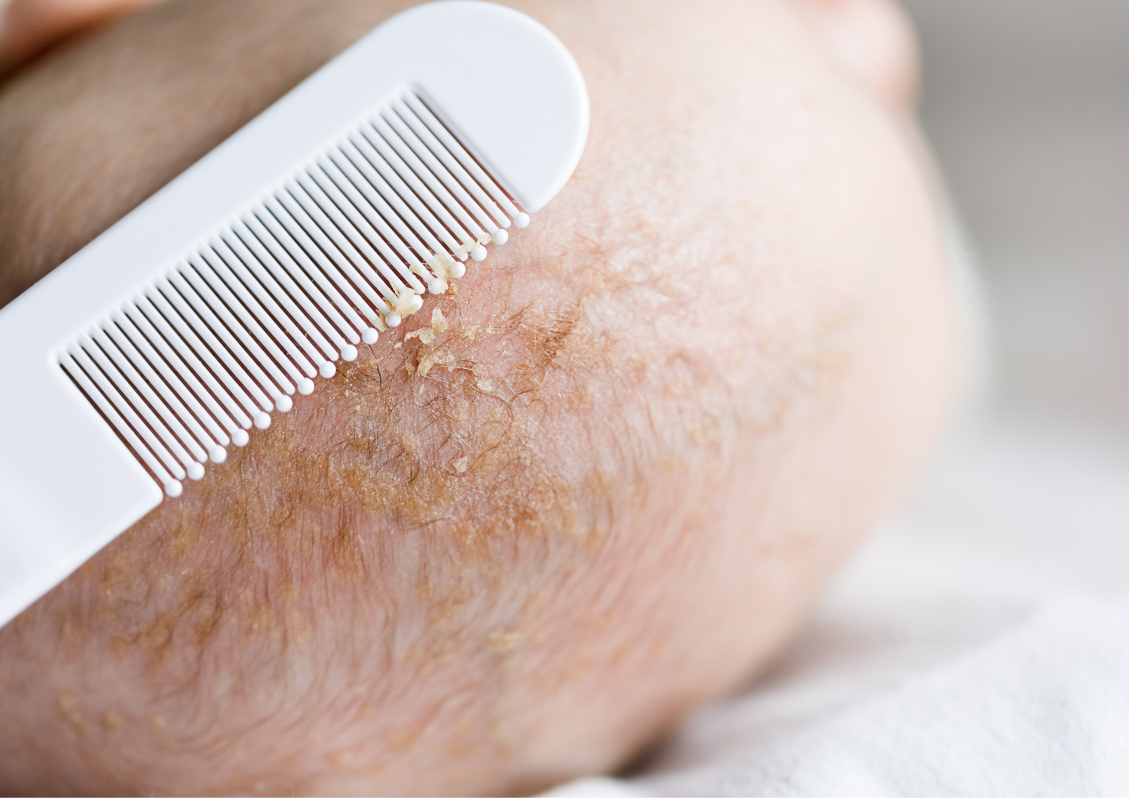 How to get rid of cradle cap fast