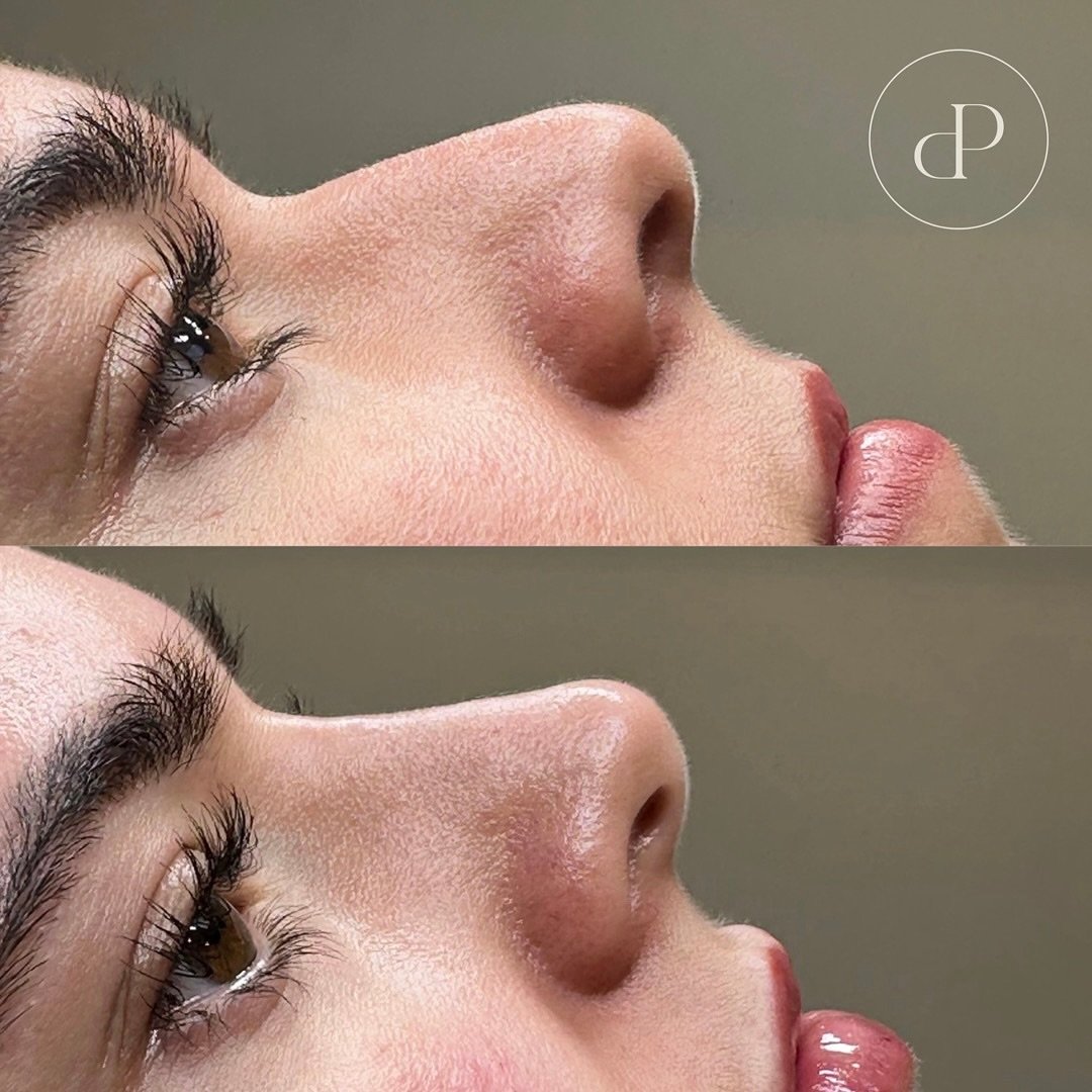 Non-surgical rhinoplasty before and after by Nurse Laura 😍

Is this treatment right for you&hellip;

Good candidates usually have the following:
&bull; Bump on the bridge of the nose (dorsal hump)
&bull; Under projected nasal tip (drooping)
&bull; C