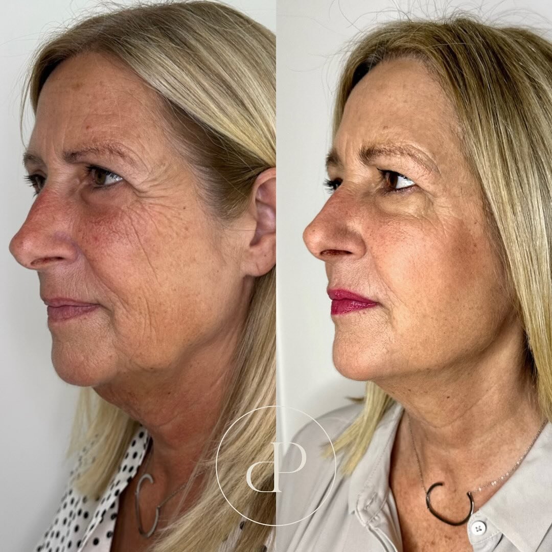10 years younger tweakments by Emily ✨😍

How amazing does our client look 😍😍

So let&rsquo;s break down the tweakments our client has had&hellip; 

&bull; Anti-wrinkle injections - to reduce fine lines and wrinkles in the forehead, frown line and 