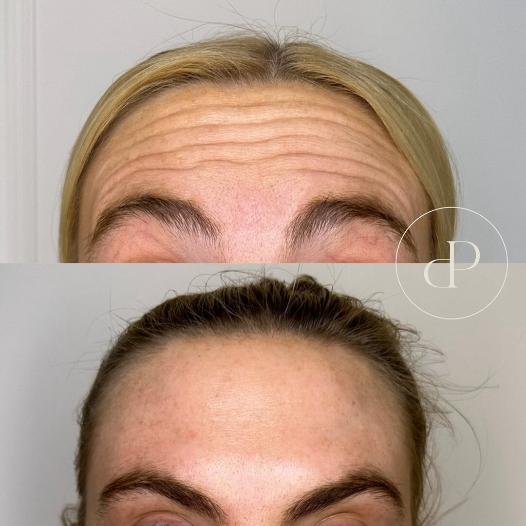 Anti wrinkle transformation by Nurse Emily 💉

These pictures are taken 14 days apart as anti wrinkle injections take up to 2 weeks to reach full affect&hellip;

As the results are not instant at your initial appointment we offer a free top up after 