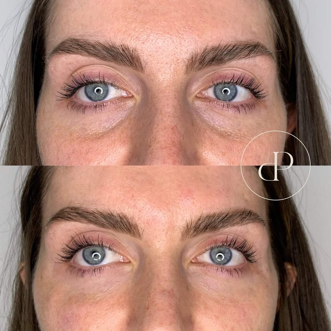 Tear trough&hellip;

Amazing tear trough results by Nurse Laura 😍

This treatment is a game changer if you have hollow or sunken eyes..

If you feel like you constantly look tired &amp; concealer is your best friend this could be the treatment for y