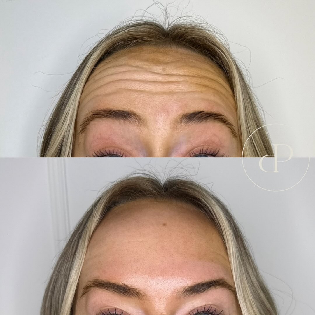 Anti-wrinkle injections by Nurse Emily 🤍

This treatments will literally knock 10-years off and clients are always shocked with their results.
⠀⠀⠀⠀⠀⠀⠀⠀⠀
Anti wrinkle injections don&rsquo;t have to look &lsquo;frozen&rsquo; or &lsquo;unnatural&rsquo;