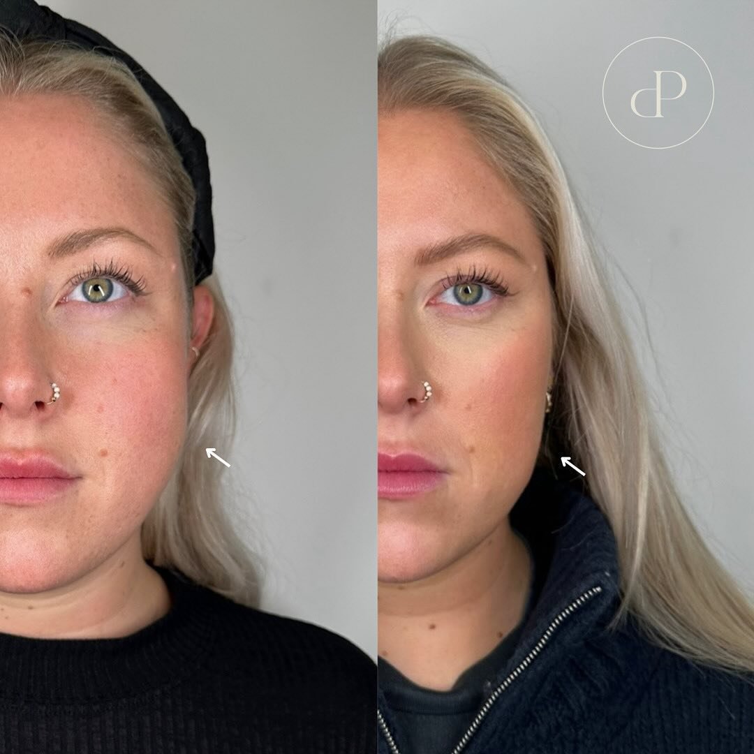 Unreal jawline slimming results by Nurse Laura 😍

We always get asked for before and afters of this treatment.. visible results are not instant and take 6-8 weeks before you start to visibly see the results..

The main benefit of this treatment is i