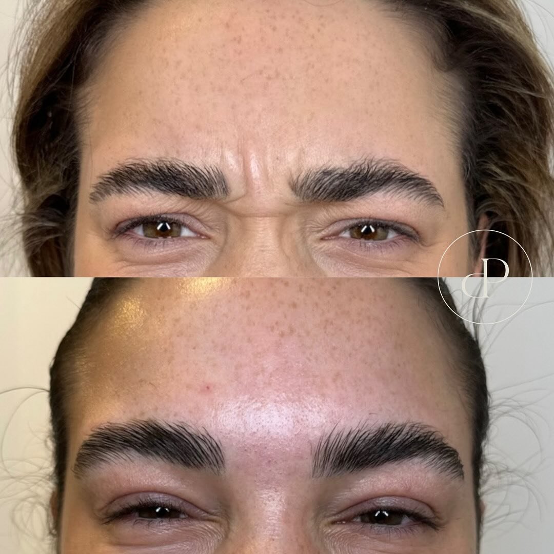 Anti-wrinkle injections by Nurse Emily 💉

Before &amp; 14 days after treatment..

Frown lines are the vertical lines that appear between the eyebrows caused by repeated frowning. This procedure involves treatment to the procerus and corrugator muscl