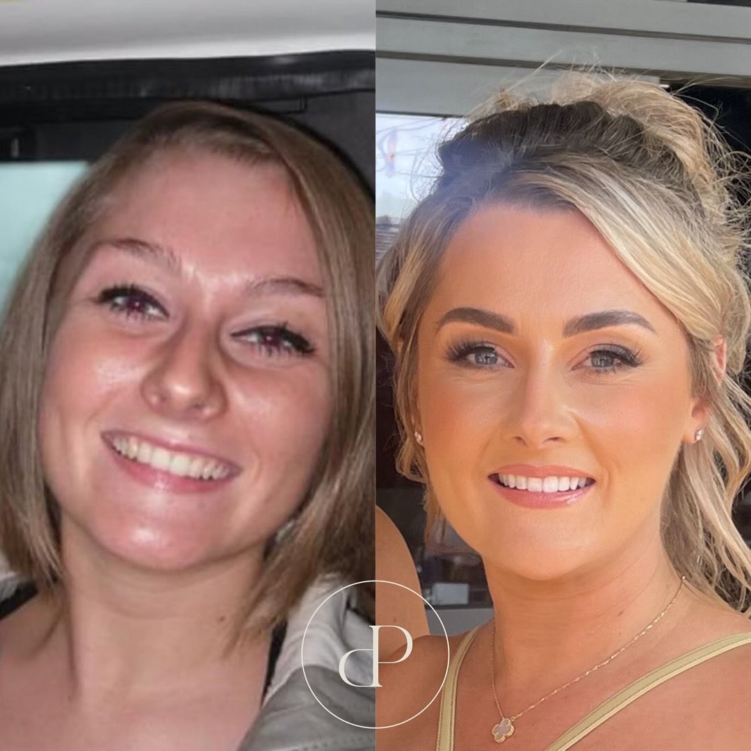 Hi everyone, it&rsquo;s Laura here! Hope you&rsquo;re all well! I just wanted to do a little post to share my aesthetics journey and to show how natural results can be! 

My before photo was taken when I was 18&hellip;..14 long years ago! Pre eyebrow