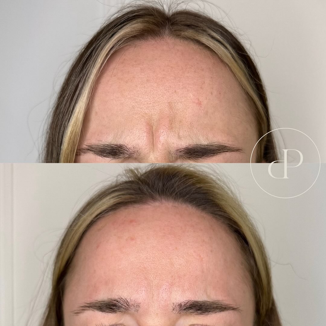 Anti wrinkle transformation by Nurse Emily 💉

These pictures are taken 14 days apart as anti wrinkle injections take up to 2 weeks to reach full affect&hellip;

As the results are not instant at your initial appointment we offer a free top up after 