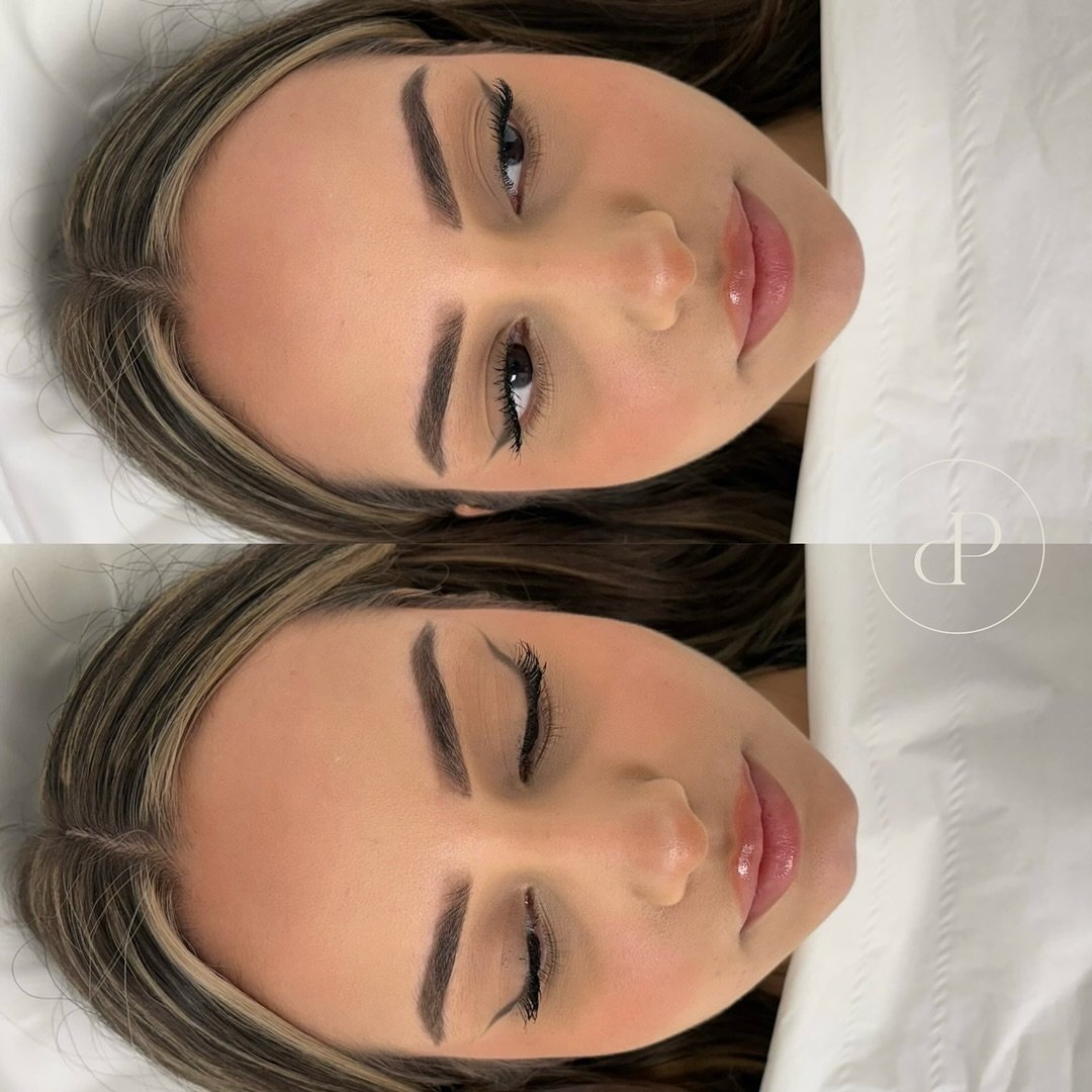 Stunning chin filler results by Nurse Stacey 😍

Did you know most people would benefit from the treatment and we promise you the results are AMAZING&hellip;

What does chin filler do?

&bull; lift and sculpt the chin &amp; jawline
&bull; create a co