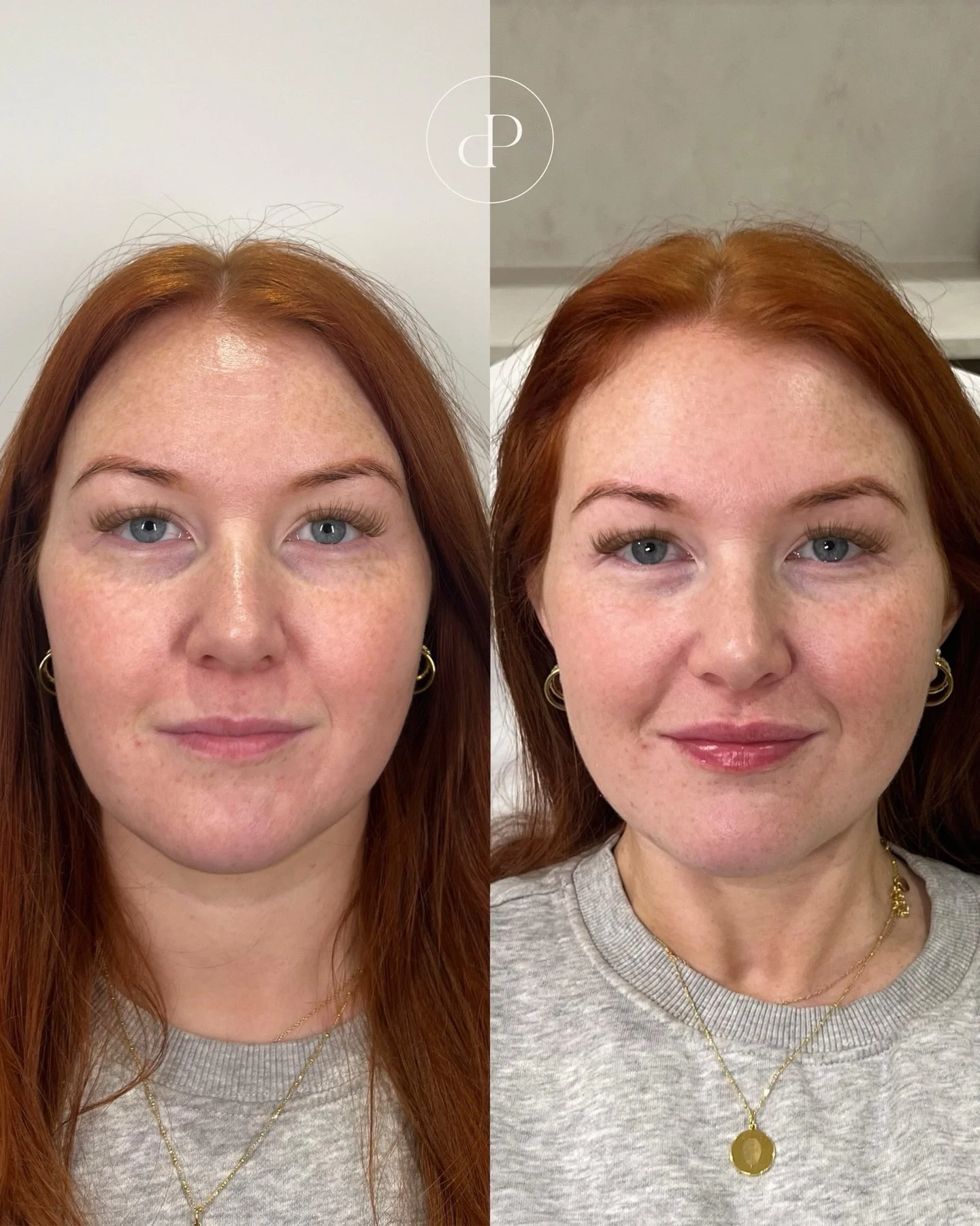 Stunning natural lip result by Nurse Megan ❤️

When done correctly lip filler isn&rsquo;t about changing your face, it&rsquo;s about enhancing what&rsquo;s already there. Our focus is always on balance, shape and subtle volume to restore youthful def