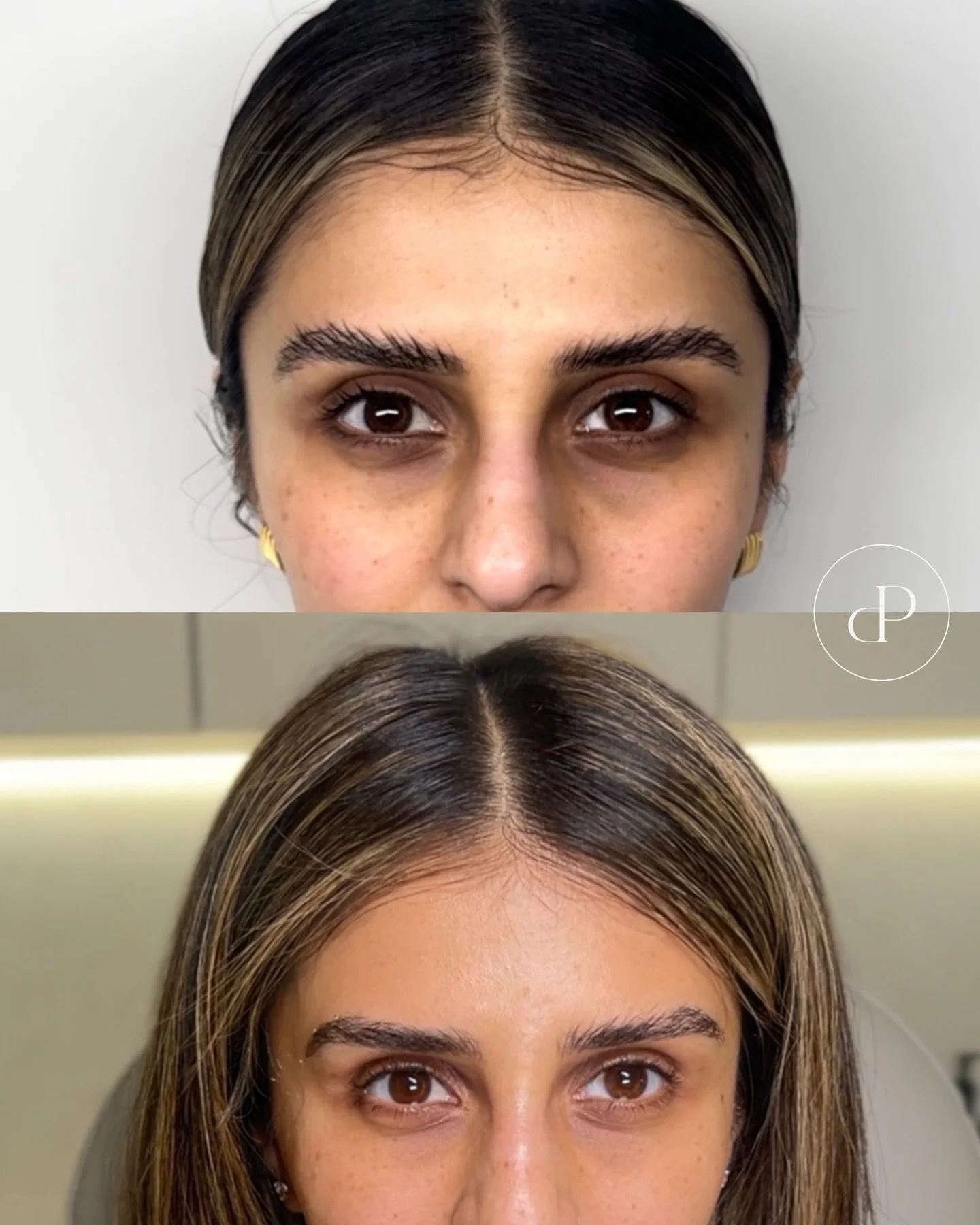 Our beautiful client @___irsa___  started a tailored DP Skin journey last year, focusing on overall skin health and targeting dark under-eye circles as a key concern.

Skincare is a journey, not a quick fix. By combining professional treatments with 