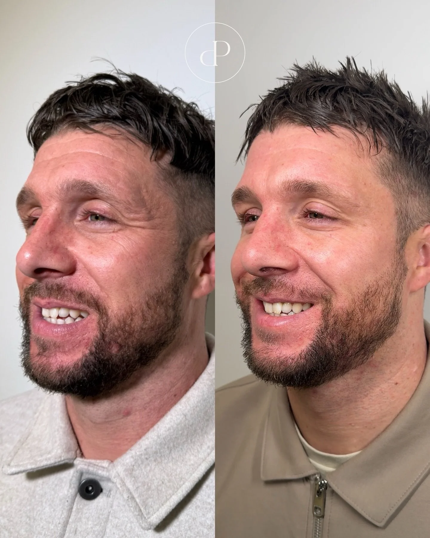 Did you know anti-wrinkle injections are now one of the most popular treatments for men?

Designed to reduce signs of ageing caused by stress, work and everyday life. Anti-wrinkle injections aim to refresh your face not change it.

Feeling confident 
