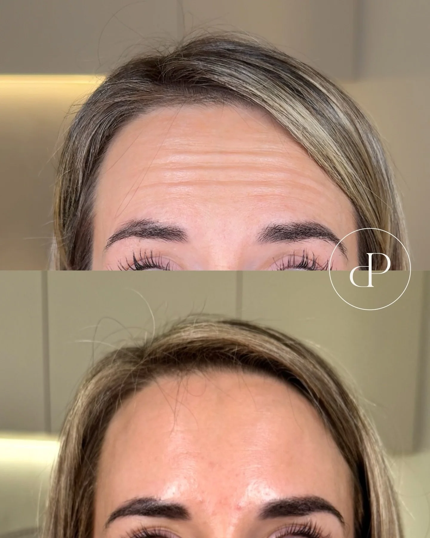 Anti wrinkle results by Nurse Megan 🤍

Are you interested in this treatment?

Did you know this anti wrinkle injections can be used to treat the following facial areas: 

&bull; Frown lines (Glabellar)
&bull; Crows feet (Orbicularis oculi)
&bull; Bu
