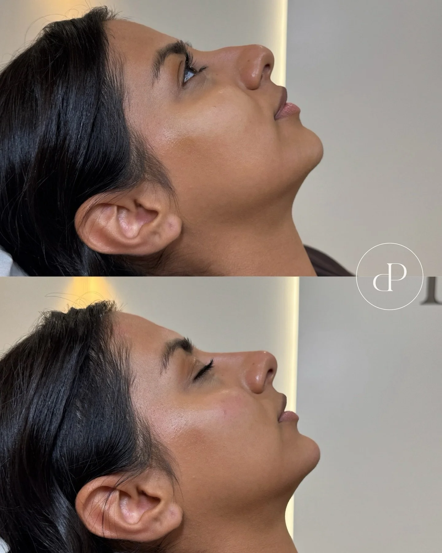 Stunning non-surgical rhinoplasty results by Emily 😍

Wow such an amazing result, super natural and subtle&hellip; nothing too obvious just a smooth transformation which elevates the side profile ✨

A good candidate for this treatment usually has th
