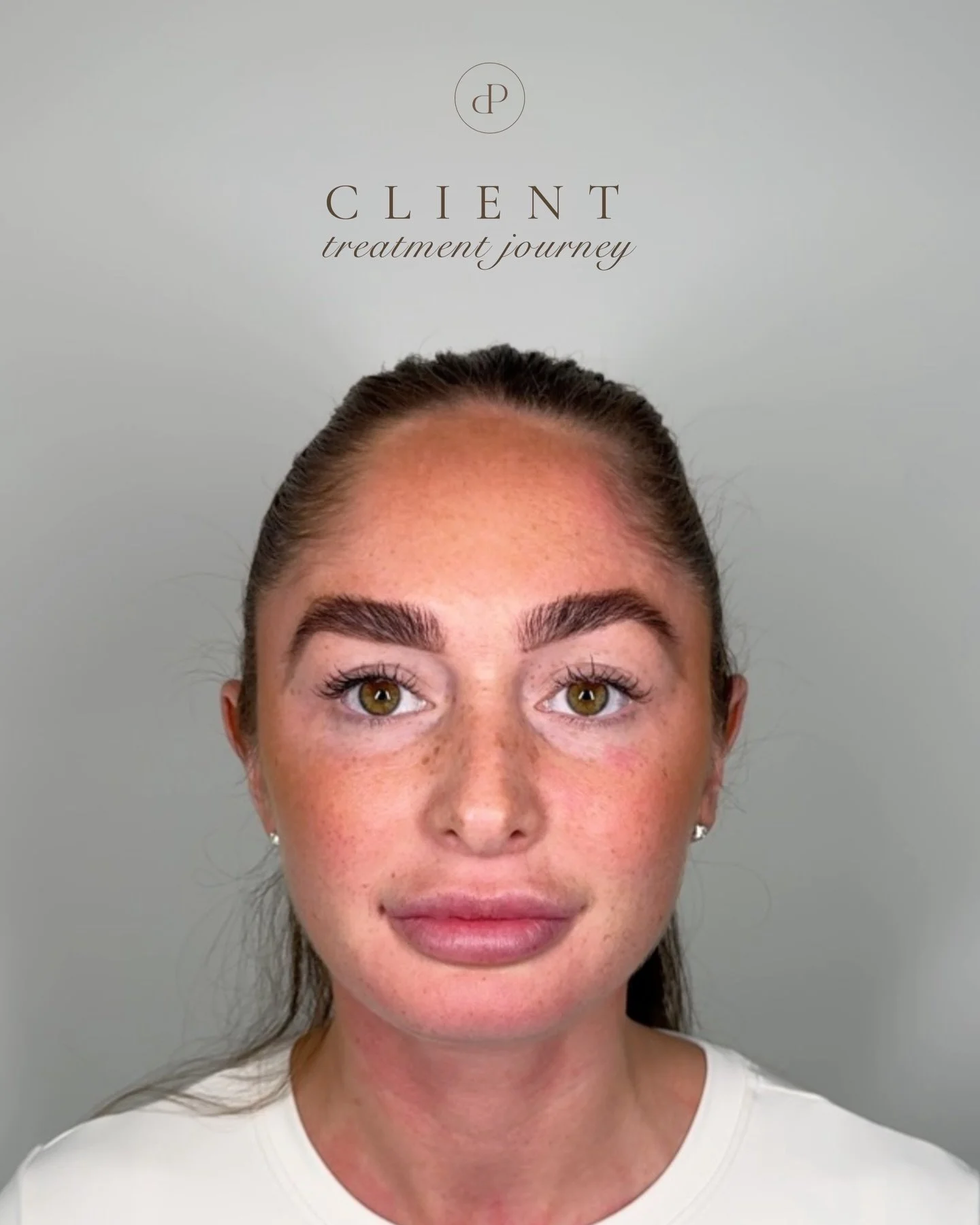 Client treatment journey&hellip; swipe to see the results ✨

This transformation journey was created over time following an in depth face to face consultation, where we discussed concerns, goals &amp; long term facial harmony planning ✨

A personalis