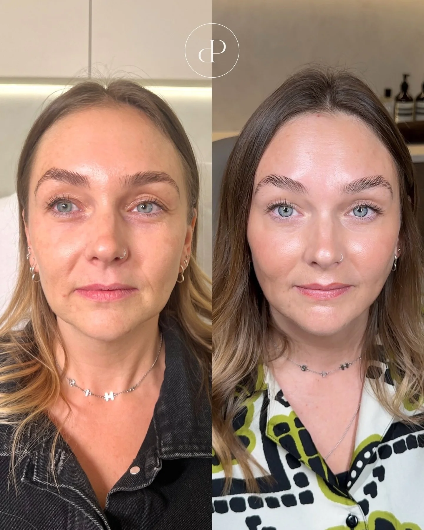 Subtle tweaks. Thoughtful placement. Natural results 🤍

These transformations are proof that dermal filler doesn&rsquo;t have to look obvious. Small amounts, placed strategically over time, can restore balance, softness &amp; refreshment whilst stil