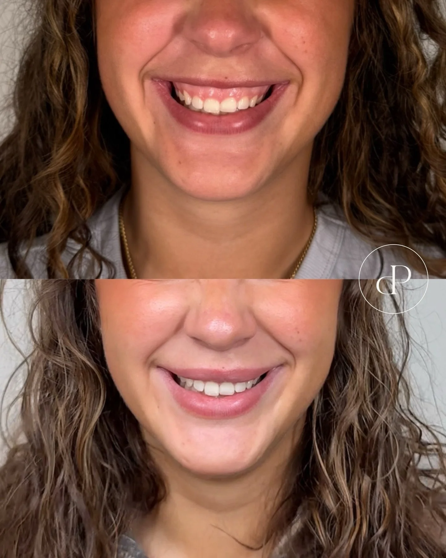 Gummy smile botox by Nurse Megan ✨

Do you notice too much gum showing when you smile? Gummy smile Botox is a precise, minimally invasive treatment designed to relax the muscles that lift your upper lip, reducing gum visibility while keeping your smi