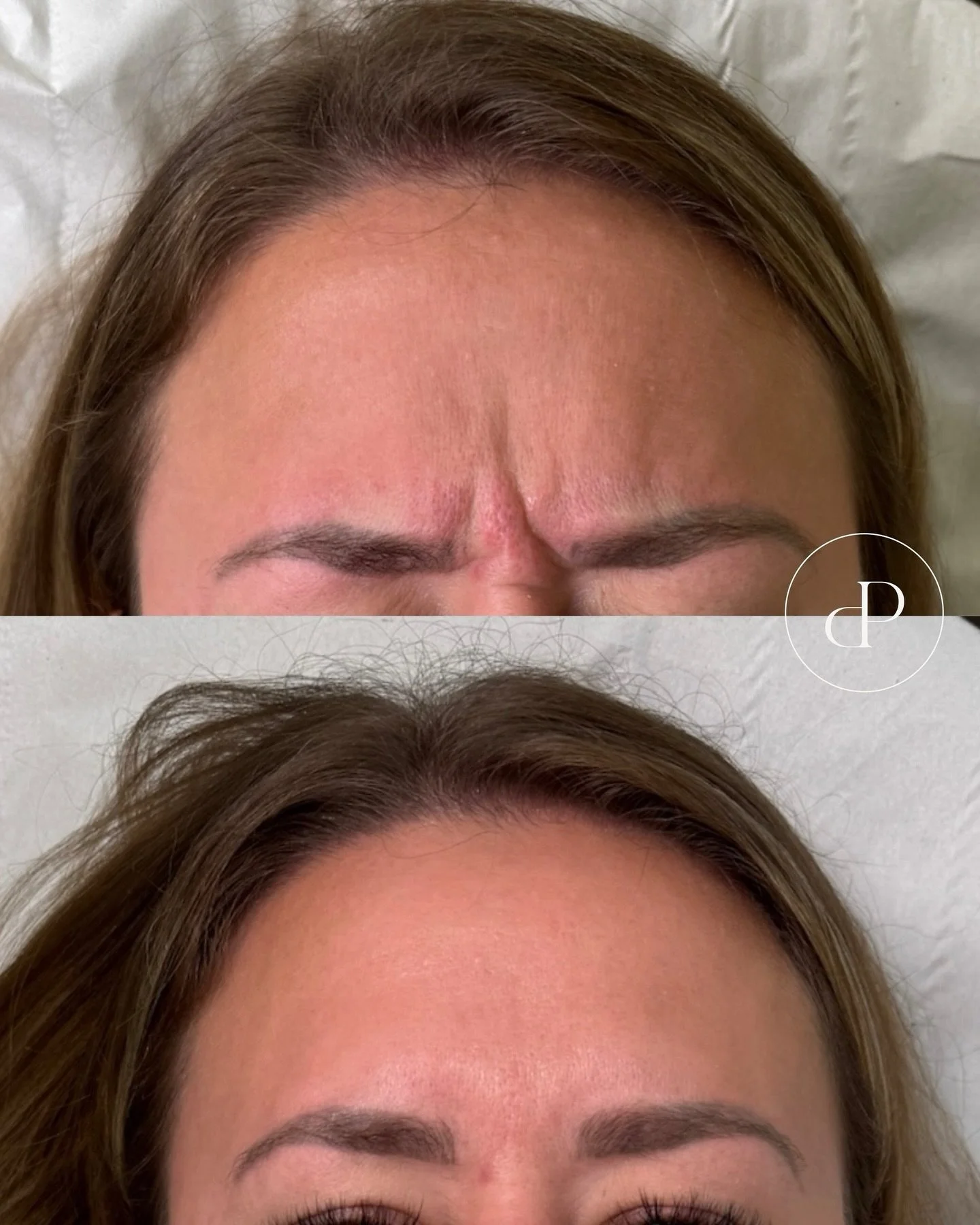 Anti-wrinkle results by Emily ✨🤍

Frown lines aren&rsquo;t always caused by age they&rsquo;re often a result of repeated muscle movement over time.

Anti-wrinkle treatment in the frown area helps relax those overactive muscles, softening existing li