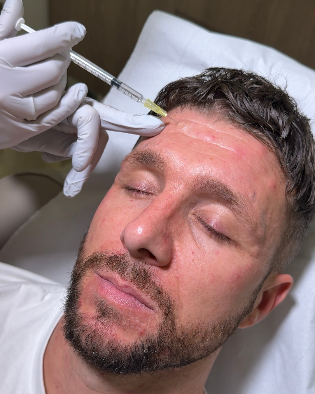 Anti Wrinkle Injections