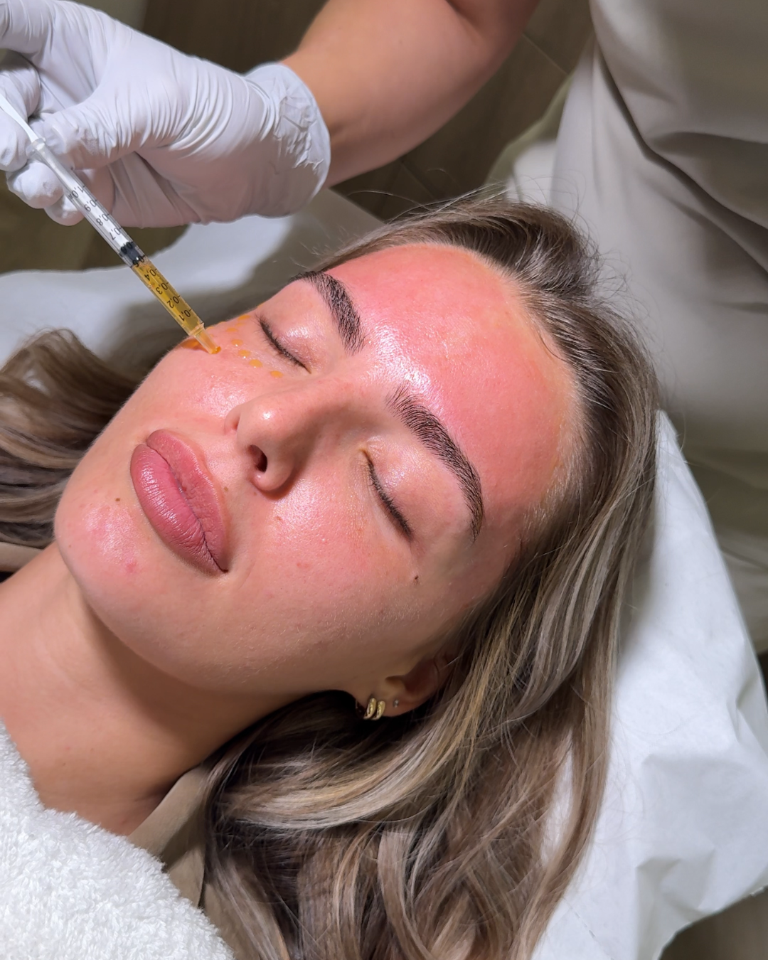 Derma Plus Medical Microneedling With Exsomes  (2).png