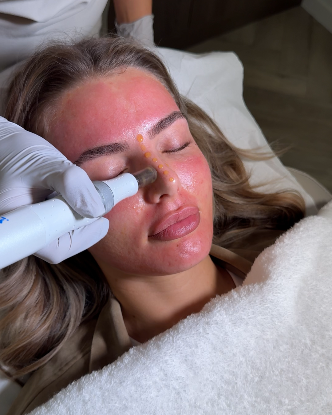 Derma Plus Medical Microneedling With Exsomes  (1).png