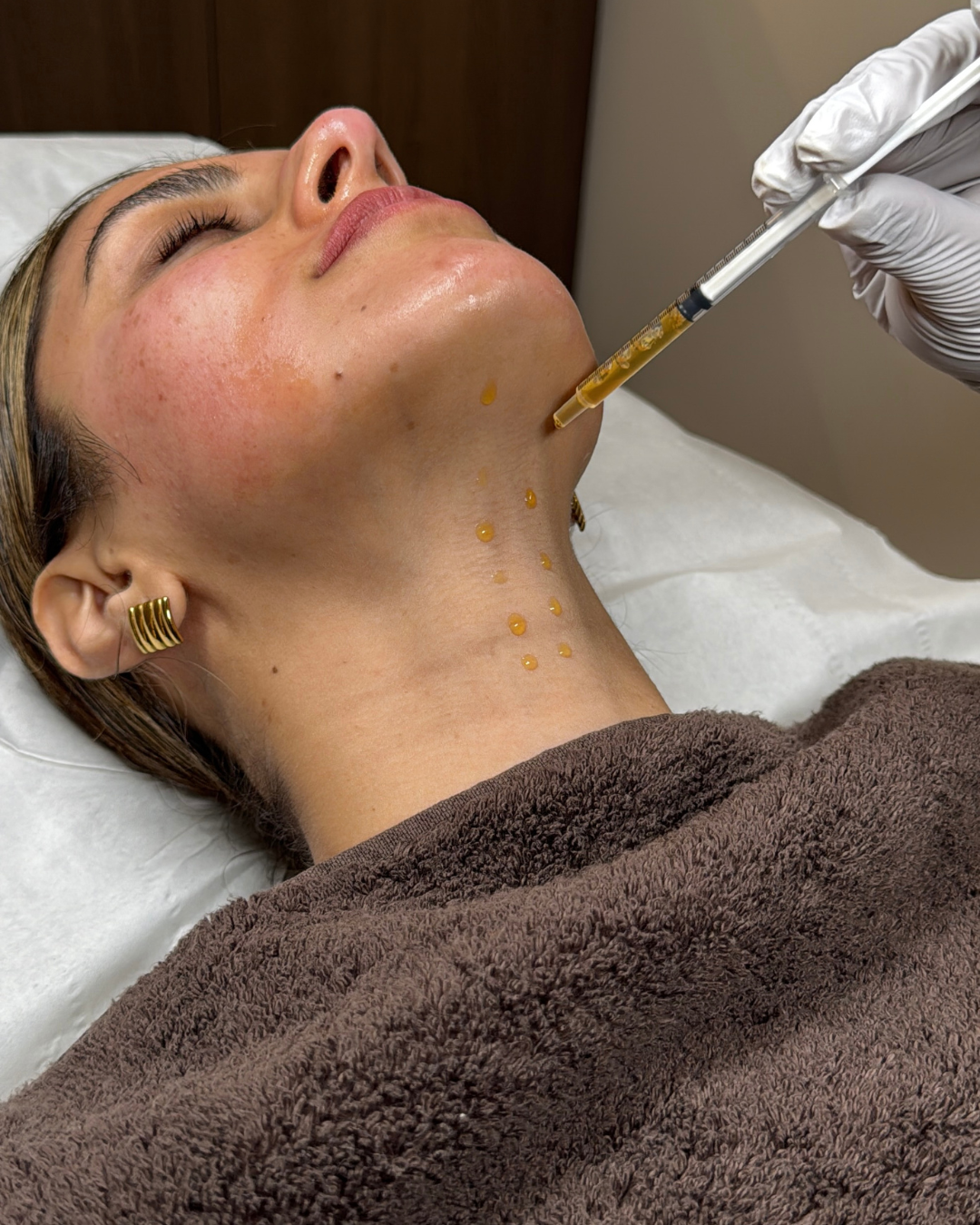 Derma Plus Medical Microneedling With Exsomes  (6).png