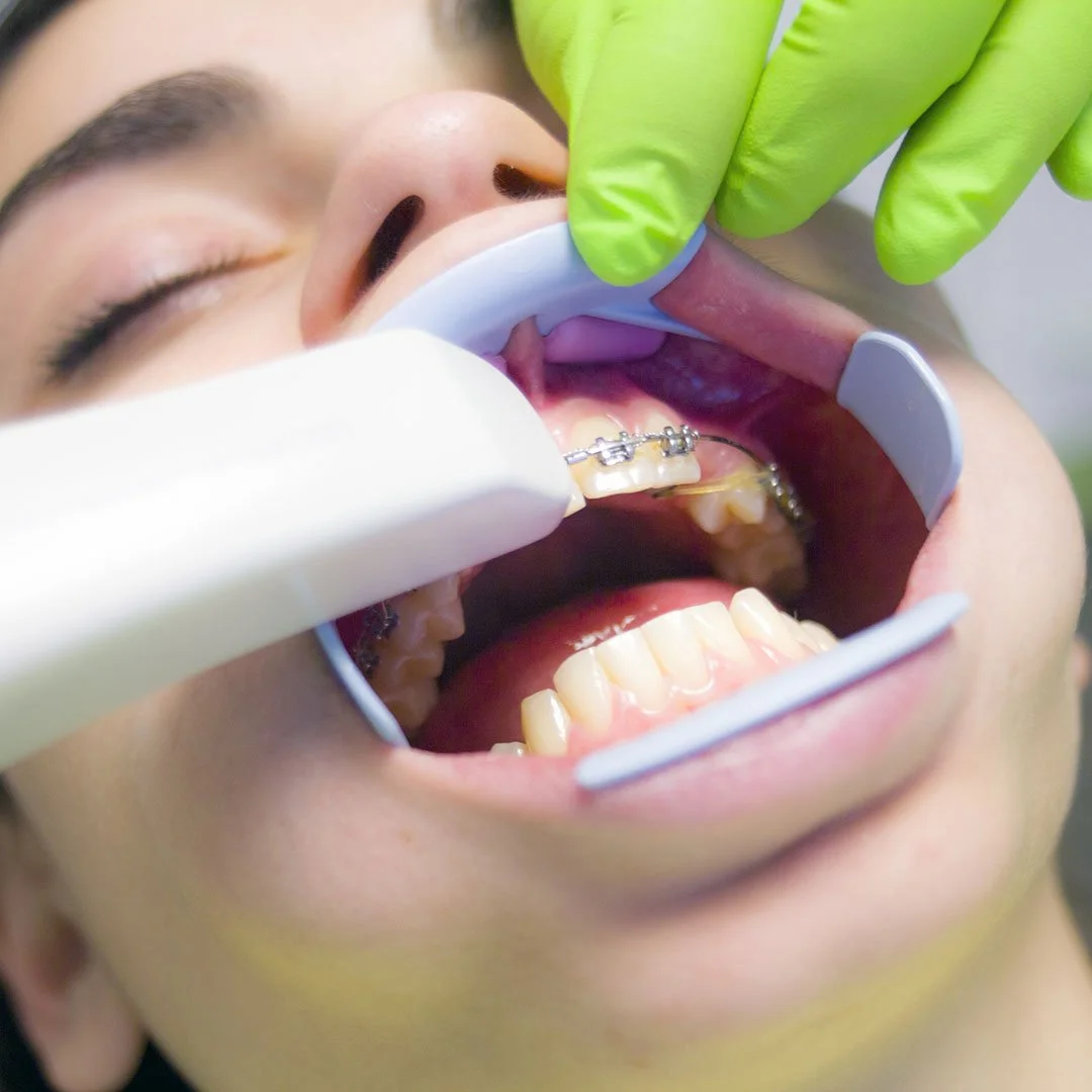 Close-up of a dental patient with braces getting dental examination with a mirror and suction device.