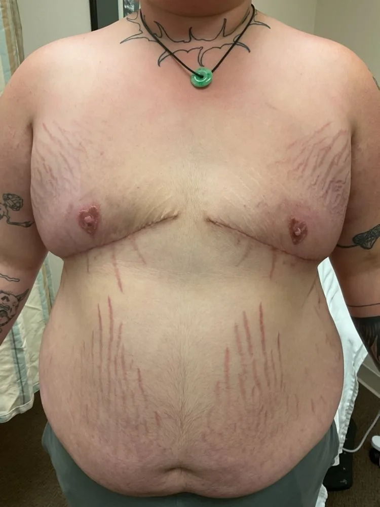 CASE 1: 2 months post-op