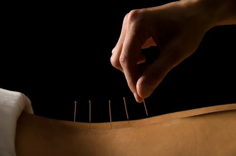 SPORTS ACUPUNCTURE