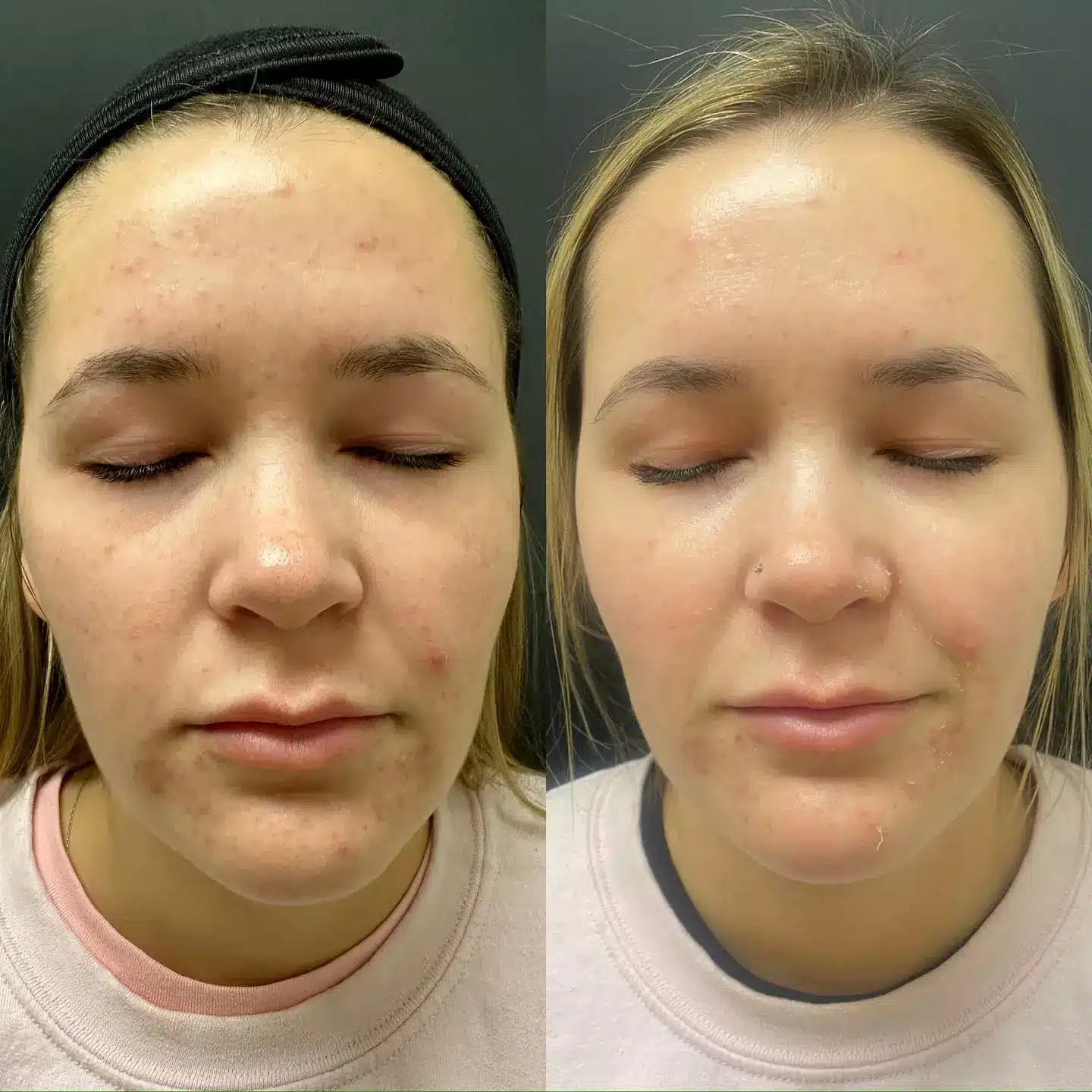 BioRePeel Benefits: Why This Chemical Peel Is Changing Skin Rejuvenation in Kirkland