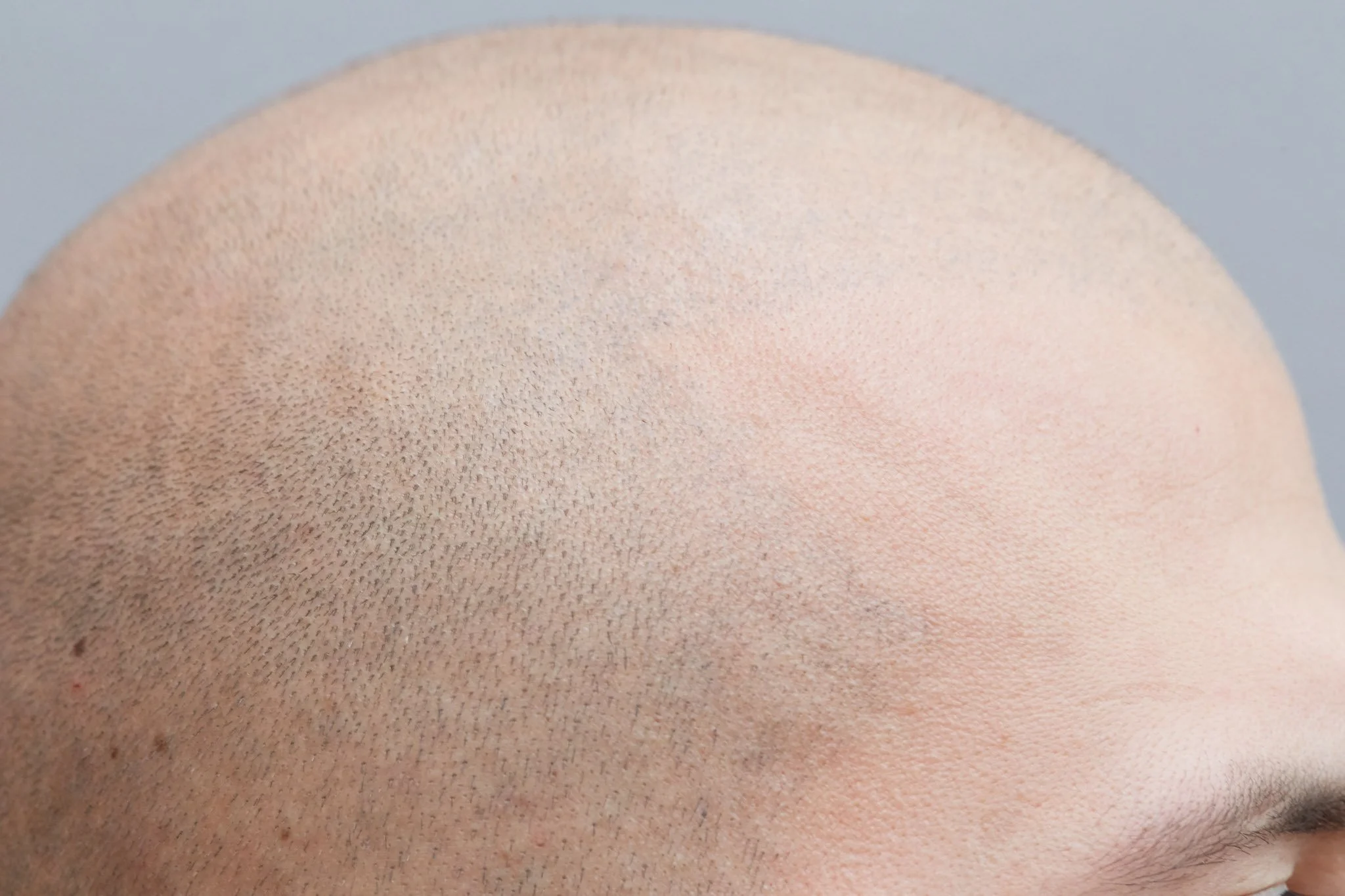 Scalp_Micro_Pigmentation