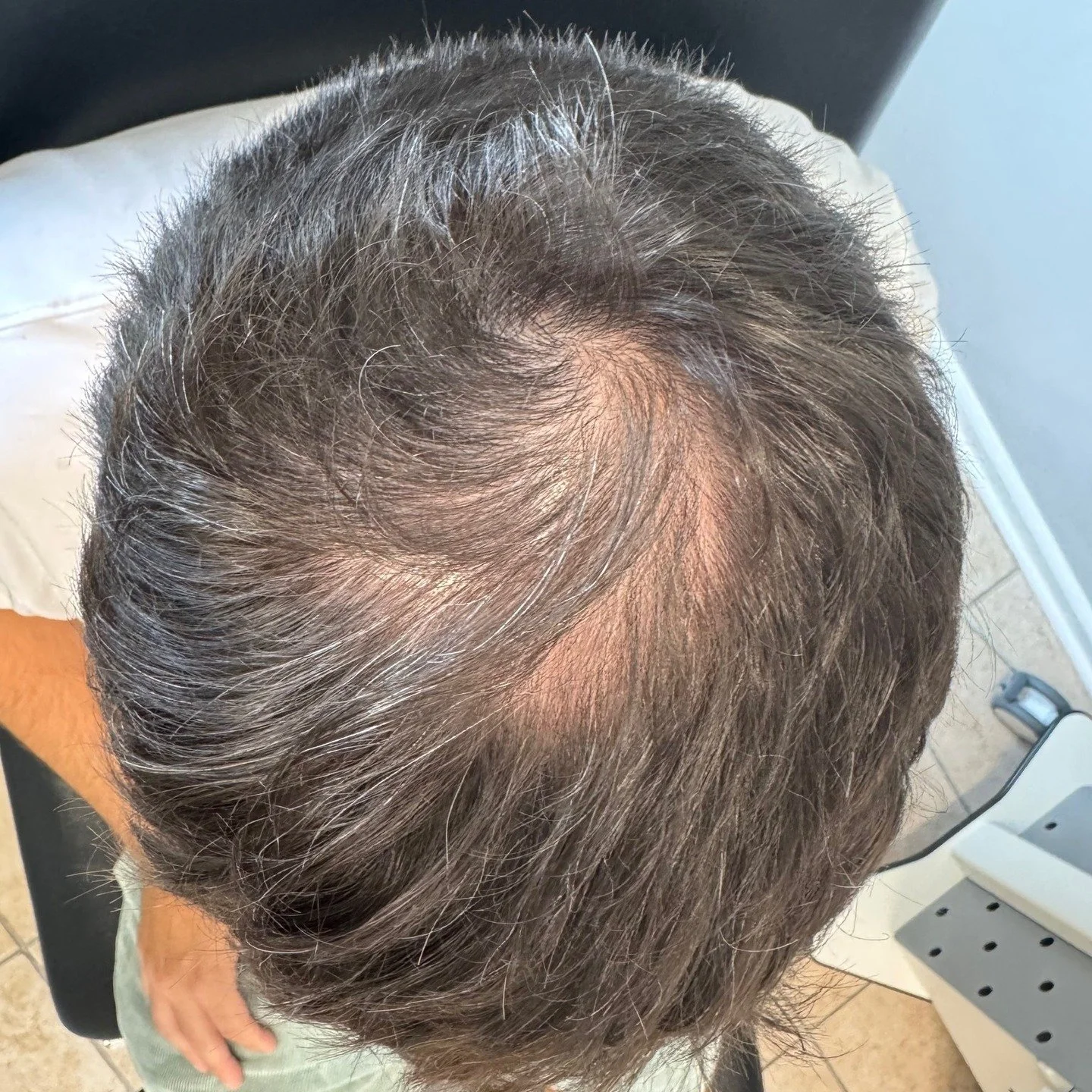 Have thinning hair? Stimulate HAIR GROWTH with Platelet Rich Plasma (PRP). Call us to schedule a consultation with Julie! #prpforhairloss #prpforhair #regenerativetherapy