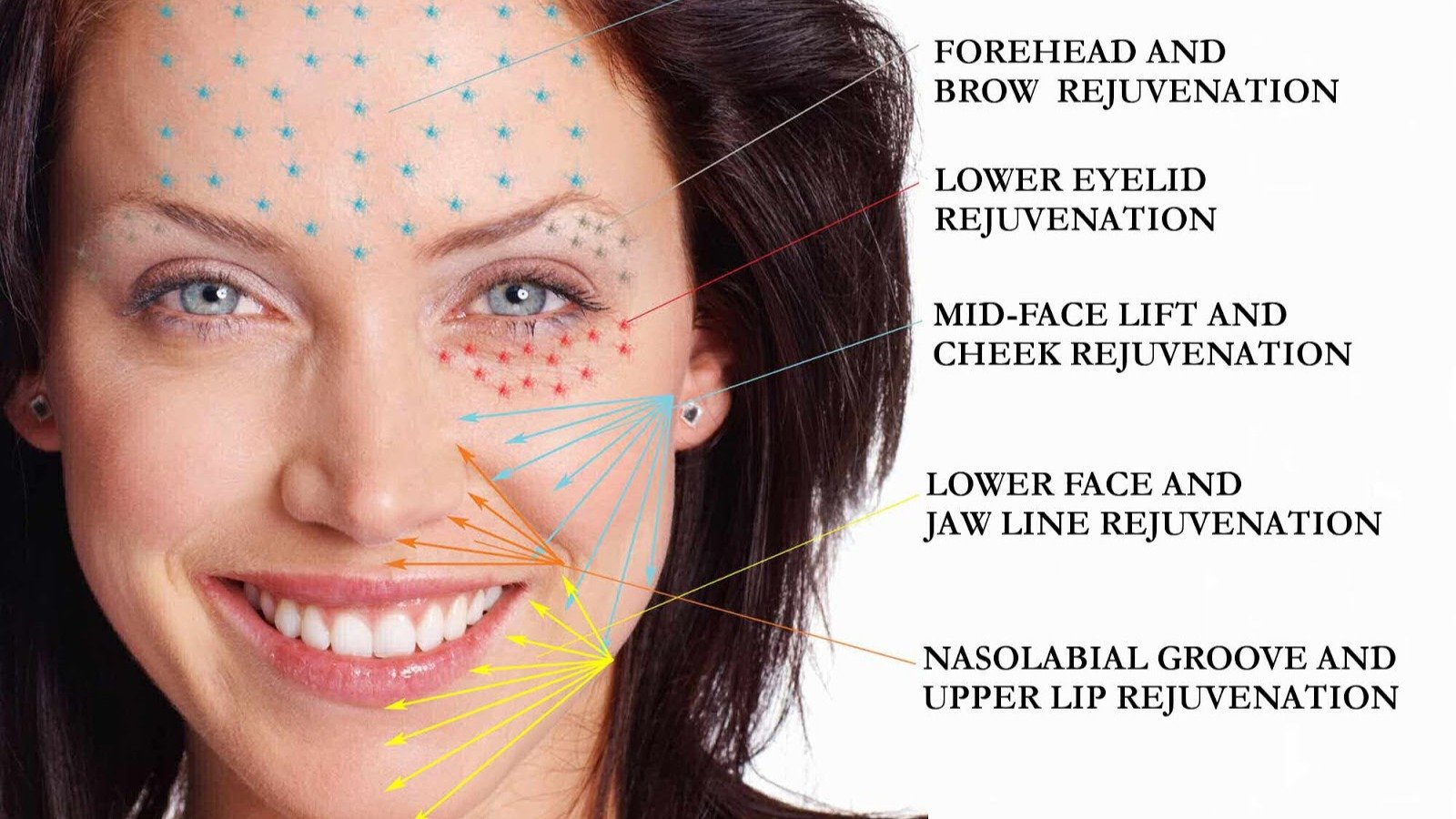 Platelet-Rich Plasma (PRP) for Facial Rejuvenation utilizes your blood samples to harness the body&rsquo;s natural healing properties. By injecting concentrated platelets into an injured or damaged area, PRP stimulates cell growth and collagen produc