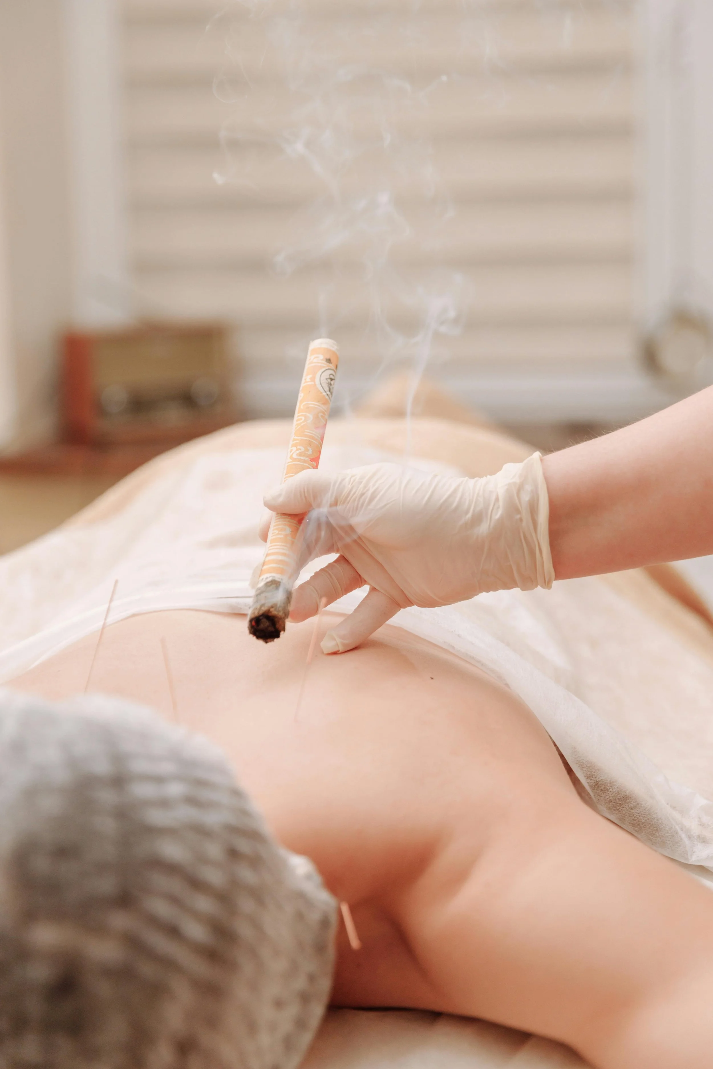 Acupuncture treatment with moxibustion on a person's back, performed by a practitioner wearing gloves.