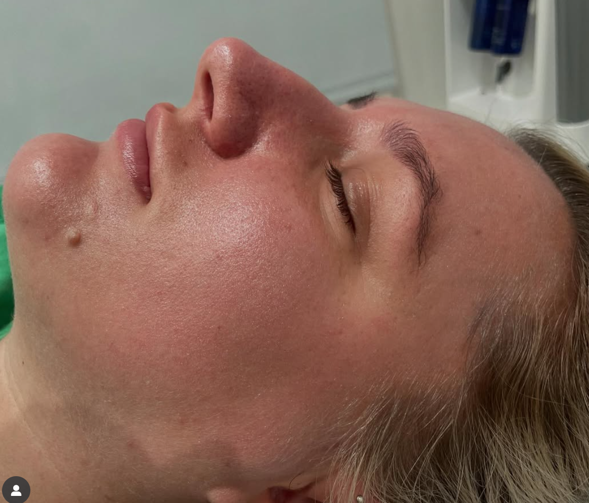 A woman has her photo taken before and after microdermabrasion with diamond tip