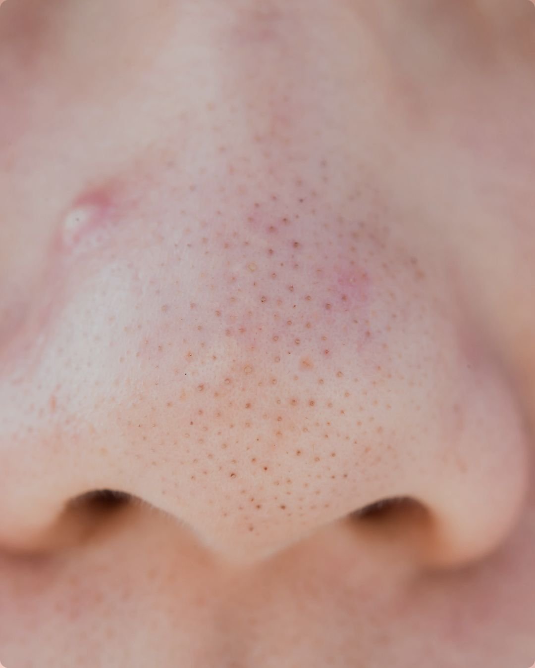 How Do I Get Rid of Blackheads? A Skin Specialist’s Guide