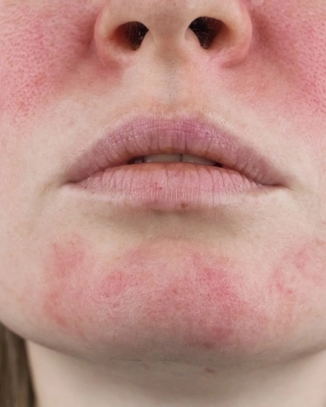 Why Does My Face Go Red? (And What Can You Actually Do About It?)