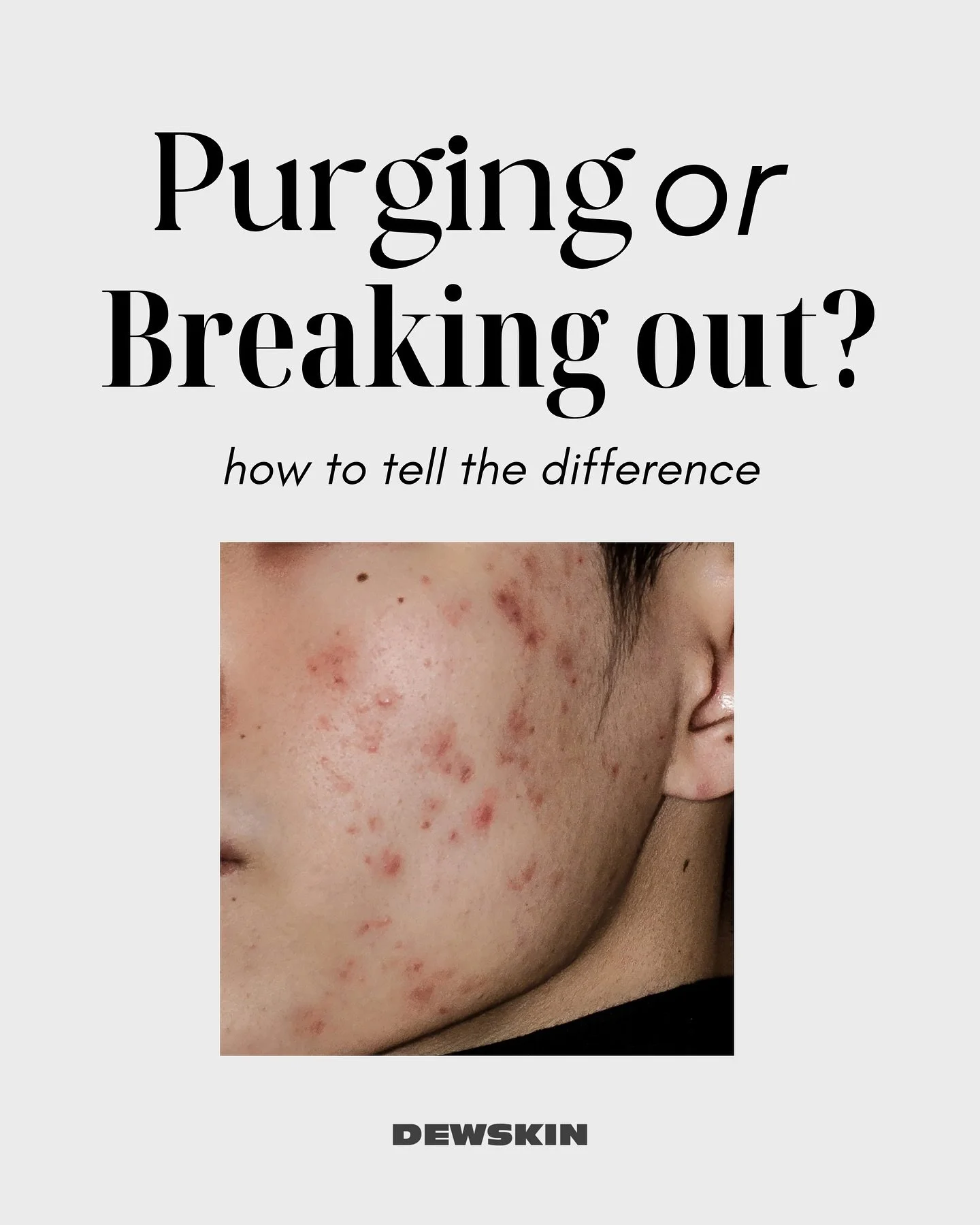 If your skin&rsquo;s been acting up lately, and you have NO idea what&rsquo;s going on - let&rsquo;s break it down 👇🏼

It could be purging or a break out&mdash;but how do you tell the diference?

When your skin&rsquo;s purging, it&rsquo;s adjusting