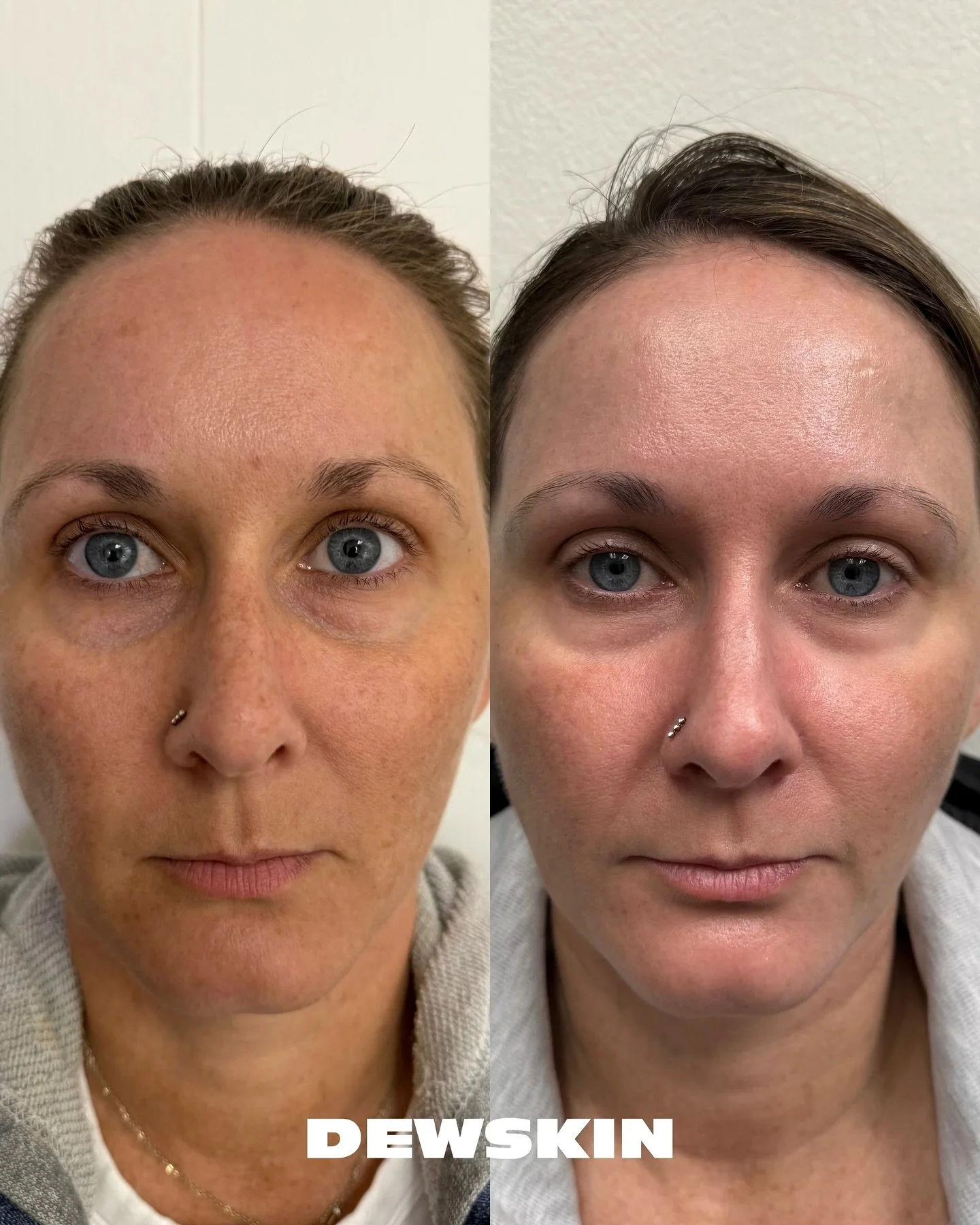 Skin health is a constant journey- and at Dewskin, we strive for progress not perfection. Just like the audio says, &ldquo;take your time, what&rsquo;s the rush?&rdquo; 

The best part of someone&rsquo;s skin journey is watching the progress, and see