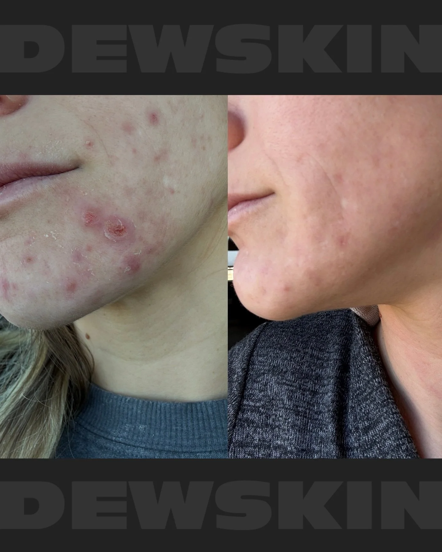 1 treatment. 4 products. 

This client came in with active acne and a compromised skin barrier. We treated her skin with the Naturapeel laser facial- giving her complexion a deep cleanse and rejuvenation, and got her on the following products:

&bull