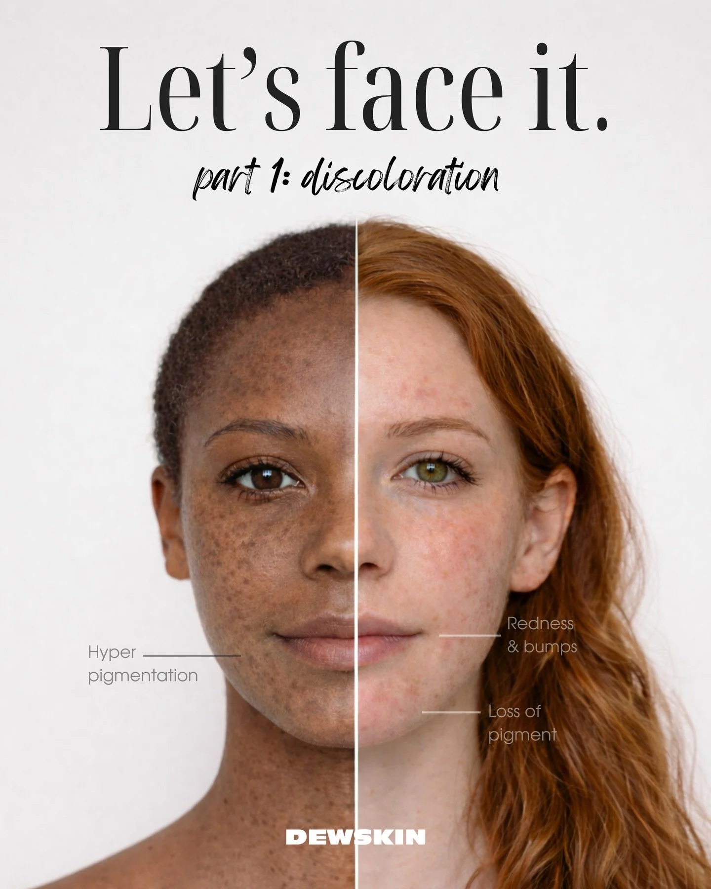 LET&rsquo;S FACE IT series. 
Part 1. discoloration 

Not all skin concerns are the same, even when they look similar. Red marks after acne are not the same as brown ones. Melasma does not behave like sun spots. Rosacea is vascular, not &ldquo;sensiti