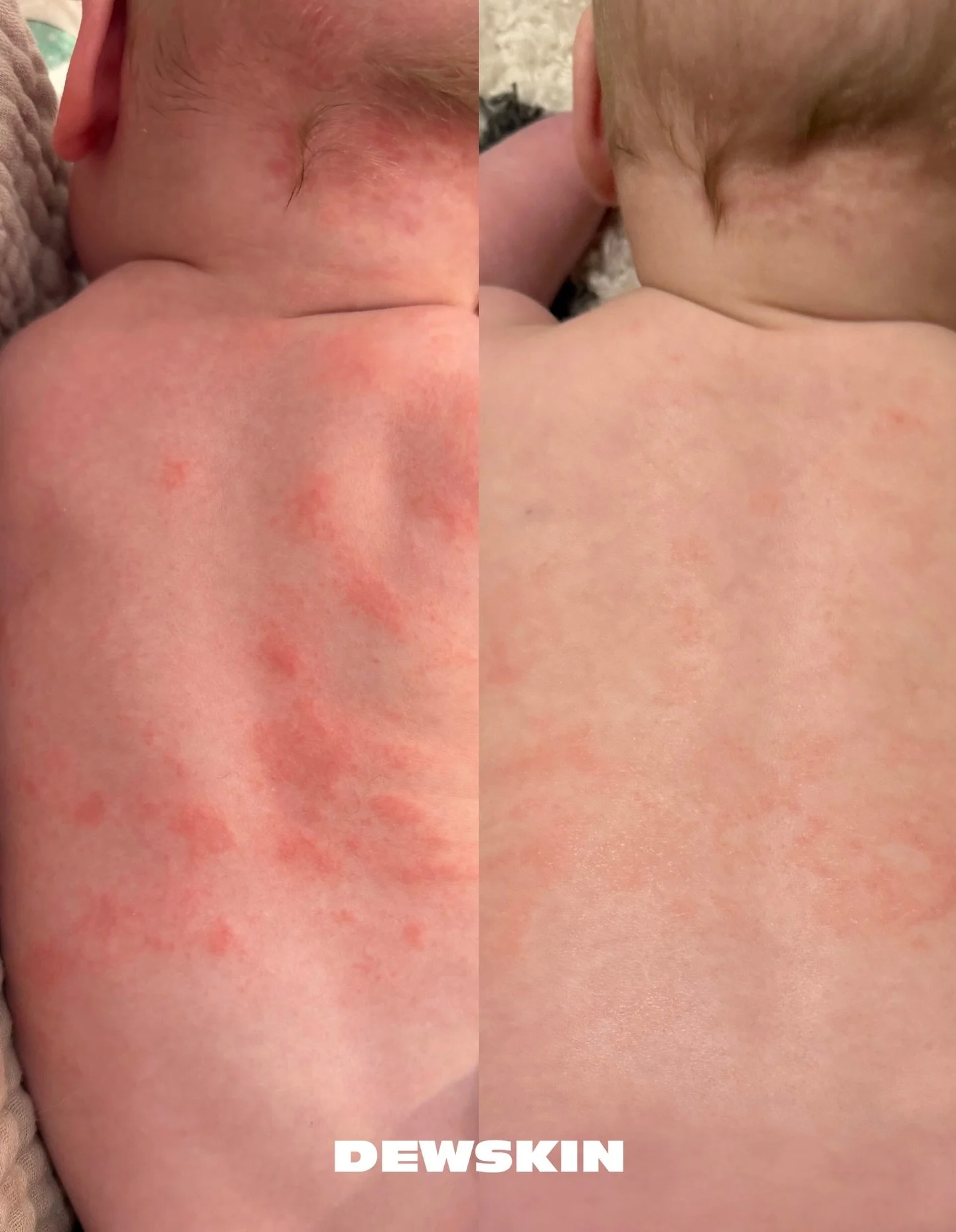 The power of @sivcare 🙌🏼

My son had a lot of dermatitis on his back that just wouldn&rsquo;t calm down. After using SIV Biome Balancing Serum, his skin looked visibly more even, less inflamed, and way less reactive after only a few days. ￼

This s
