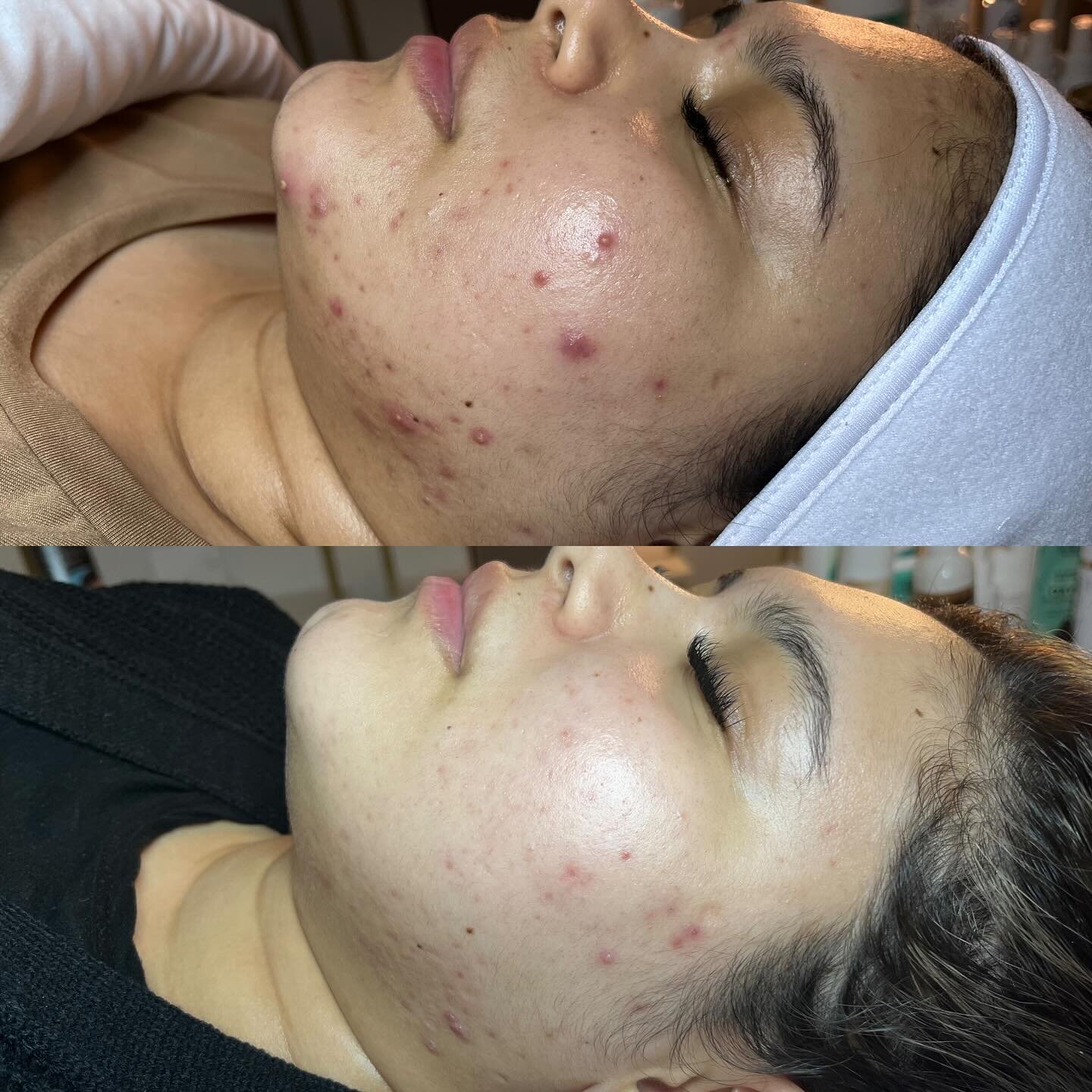 How it started vs. how it&rsquo;s going ✨

How absolutely beautiful is she?! Photos are 4 months apart with just 3 customized treatments with me. 🥹🤯

Addressing the inflammatory factors and incorporating homecare first made treating her skin a bree