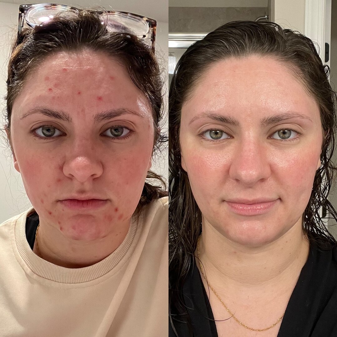 Invest in yourself. Invest in an Esthetician. ⁣

I wish I was kidding when I say these photos are 6 DAYS APART from eachother. 🥹

I could not be happier for my sweet client and friend. She decided this was THE year she was going to investing in her 