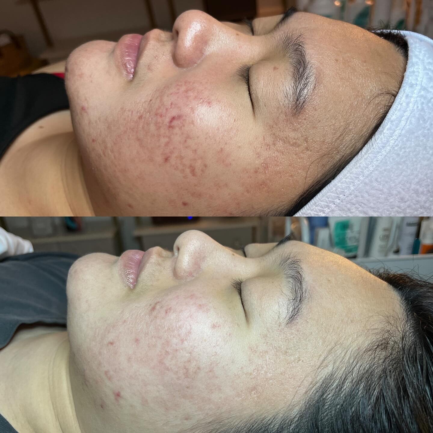 Progress over perfection. Any day. 😘🤌🏼❤️

This month, this beautiful angel and I are celebrating a YEAR of monthly facials, a proper skin regimen and commitment to her overall skin health! 🥲

Her skin barrier has not only improved, but we have al