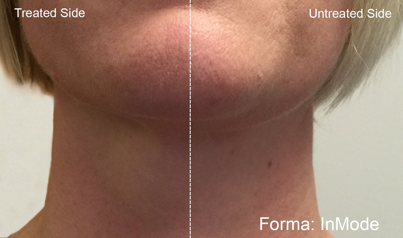 forma-before-after-inmode-preview-1.jpg