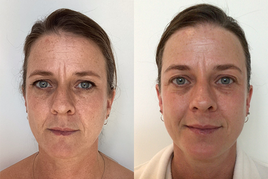 Microneedling-Before-and-after2.png