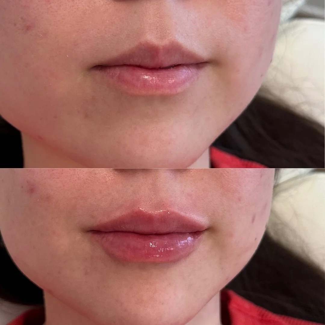 Tox + Filler B&A's  - 2026-03-17T094128.191.jpg